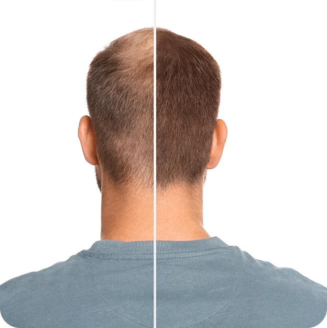 Best Hair Transplant in Kolkata with FUT & FUE transplantation at Elation Hair and Skin Care Clinic